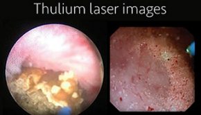 Super-pulsed thulium laser used on kidney stones.