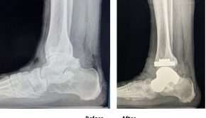 3D Printing Technology Revolutionizes Foot and Ankle Surgery