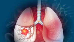Novel AI blood testing technology for lung cancers identification developed