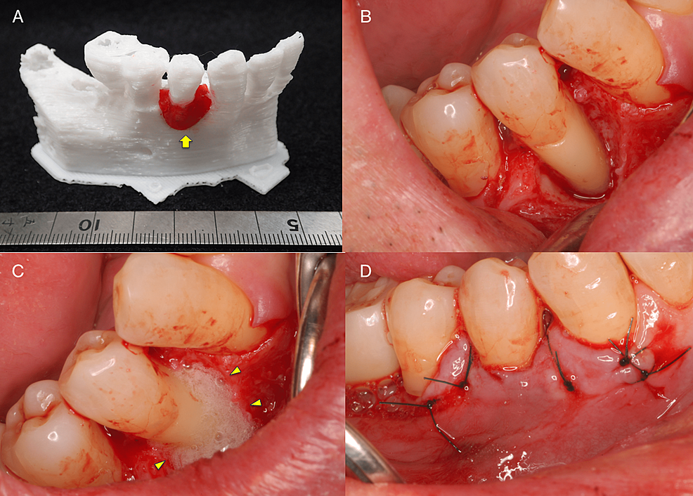 3D-model-used-for-the-FDF-2-medicine-applicative-simulation-and-photographs-during-periodontal-surgery.