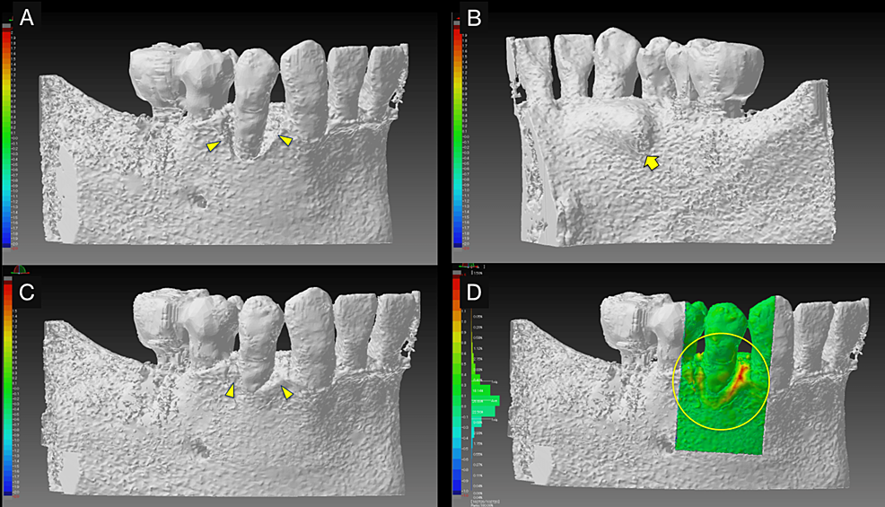 3D-views-of-pre--and-post-operative-cone-beam-computed-tomography-(CBCT)-images-and-superimposed-images-of-pre--and-post-operative-CBCT-images.