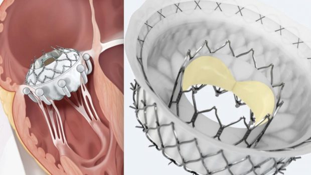 Advances in transcatheter tricuspid and mitral valve technology