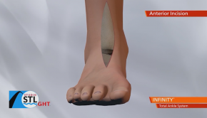 Ask the Expert: New technology for ankle pain offered by Signature Orthopedics - fox2now.com