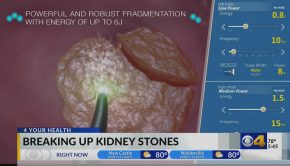 IU Health uses new technology that obliterates kidney stones