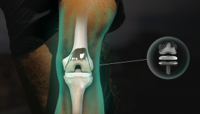Invest in a New Knee Replacement Technology That Could Change Joint Surgeries Forever