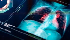 New 'revolutionary' robotic technology helps both treat and prevent lung cancer in one shot