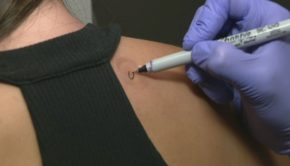 New technology allows doctors to test for skin cancer via stickers that collect skin cells
