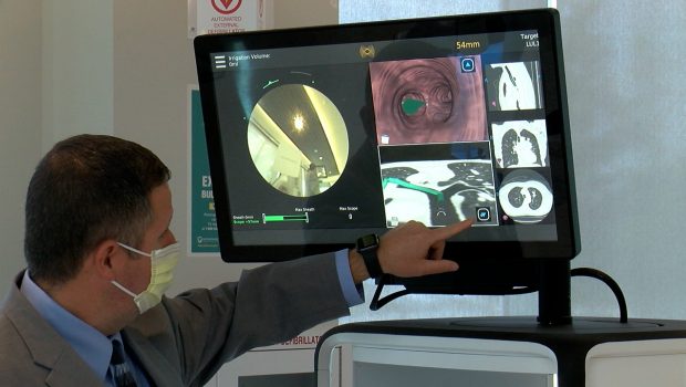 Penn State Health new technology detecting early stages of lung cancer