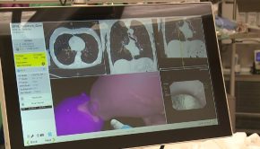 Trumbull Regional Medical Center’s new GPS-like technology helps detect lung cancer