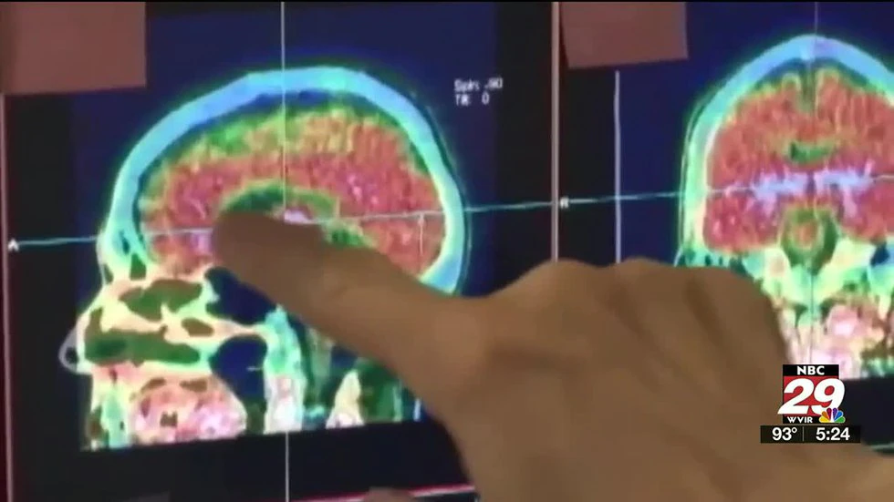 UVA researchers use imaging technology to target epileptic seizures